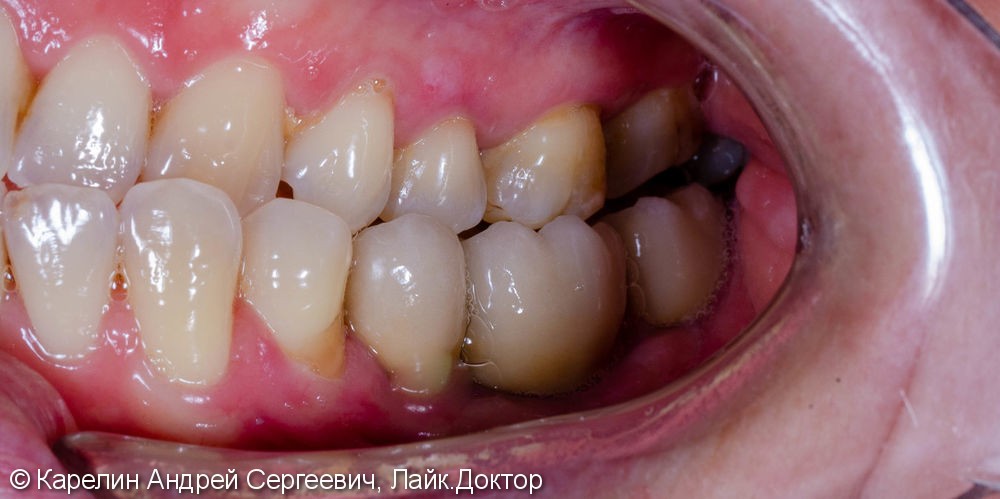 Восстановление отсутствующих зубов с помощью имплантатов. - фото №11