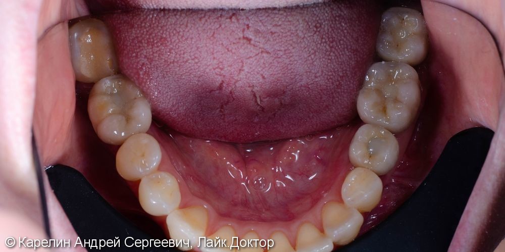 Восстановление отсутствующих зубов с помощью имплантатов. - фото №12