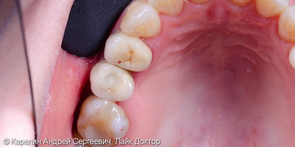 Восстановление отсутствующих зубов с помощью имплантатов. - фото №13