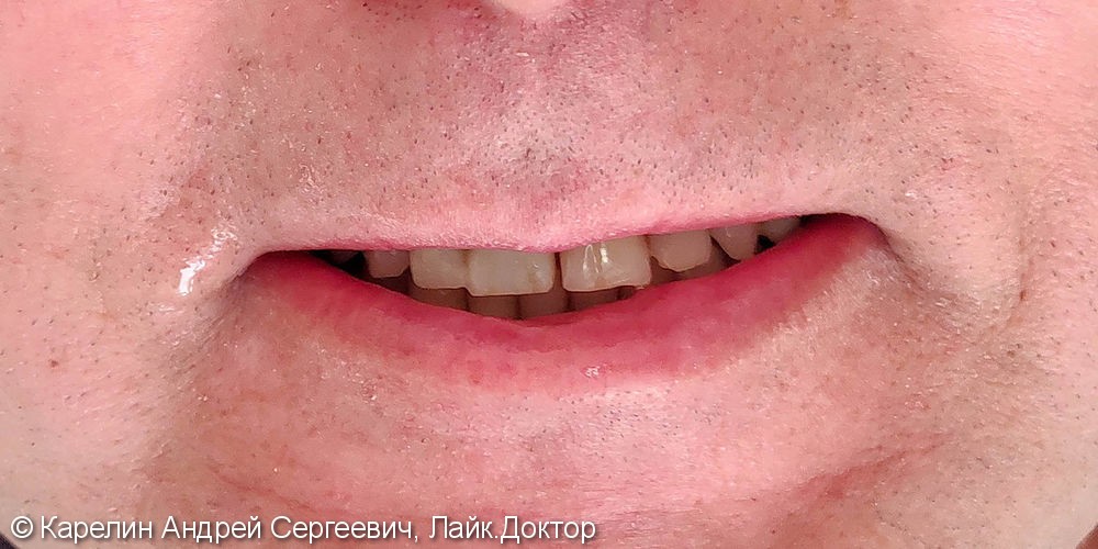 Восстановление эстетики во фронтальном отделе верхней челюсти с помощью имплантатов. - фото №7