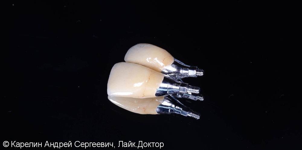 Восстановление эстетики во фронтальном отделе верхней челюсти с помощью имплантатов. - фото №10