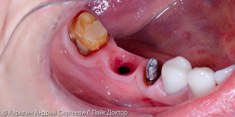 Диоксид циркония на зубы и имплантат - фото №1