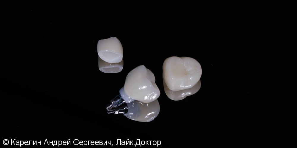Диоксид циркония на зубы и имплантат - фото №2