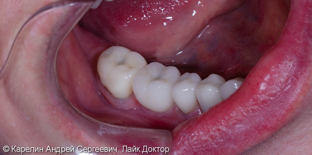 Диоксид циркония на зубы и имплантат - фото №3