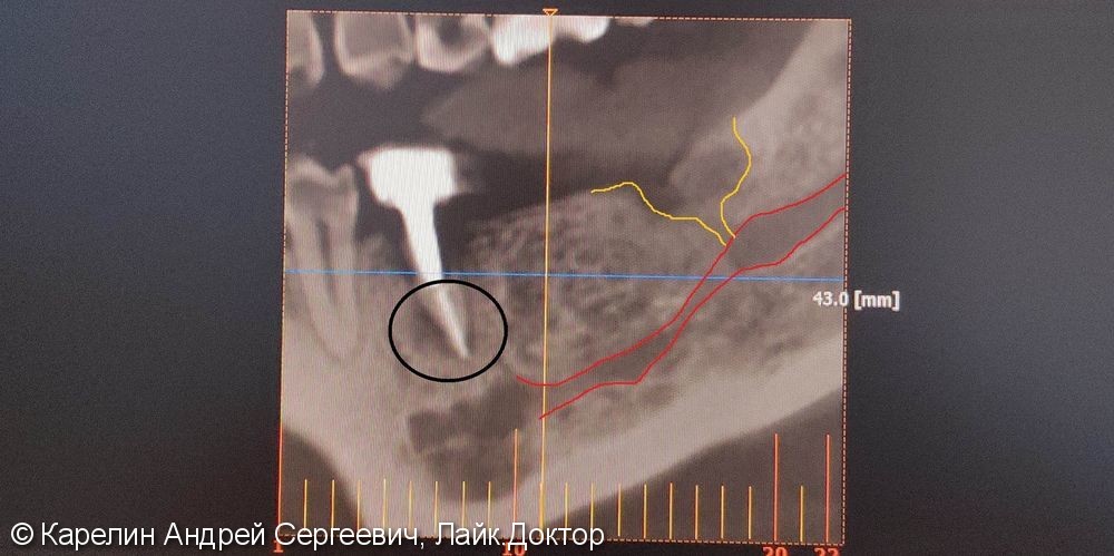 Травма нижнечелюстного нерва после резекции корней 3.7 зуба - фото №3