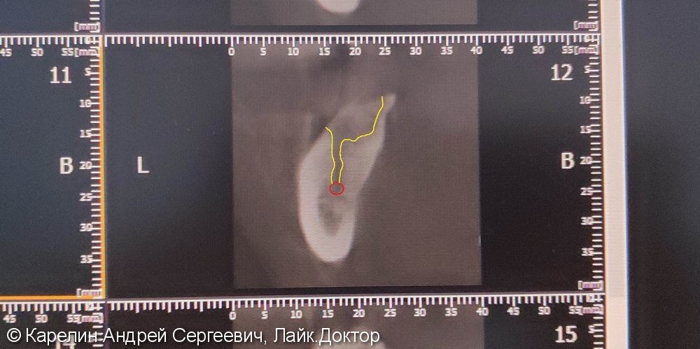 Травма нижнечелюстного нерва после резекции корней 3.7 зуба - фото №4