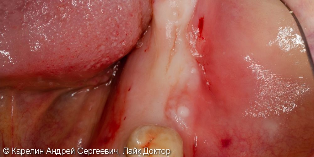 Травма нижнечелюстного нерва после резекции корней 3.7 зуба - фото №5