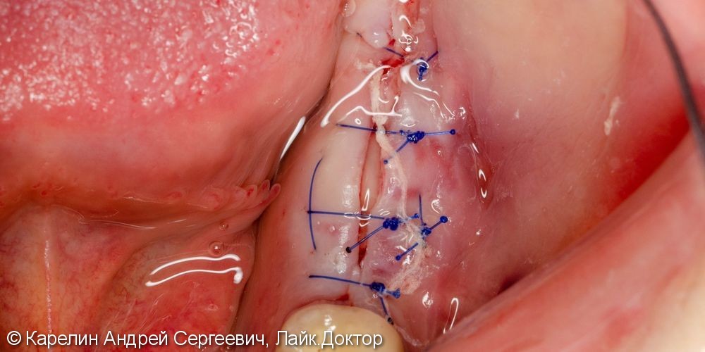 Травма нижнечелюстного нерва после резекции корней 3.7 зуба - фото №6