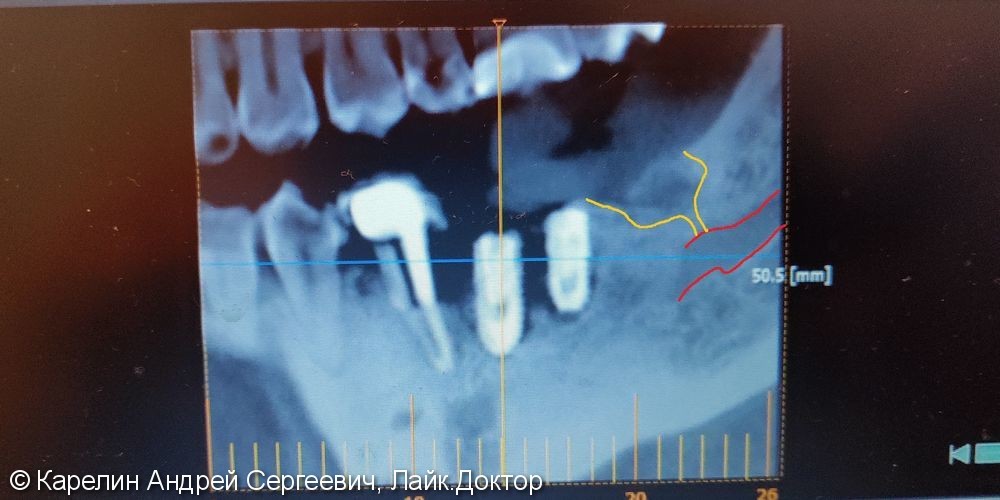 Травма нижнечелюстного нерва после резекции корней 3.7 зуба - фото №7
