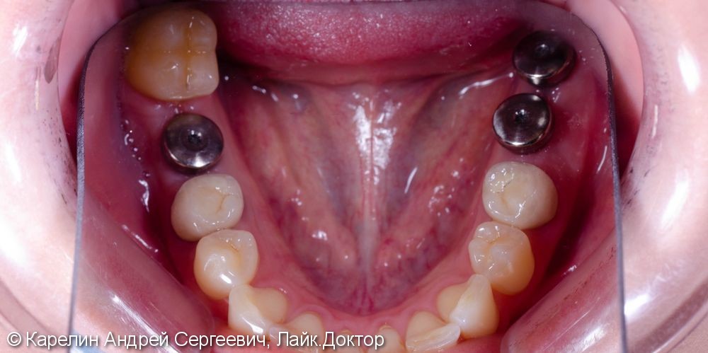 Травма нижнечелюстного нерва после резекции корней 3.7 зуба - фото №8