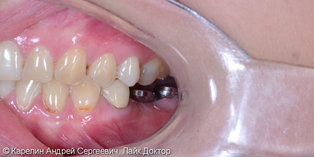 Травма нижнечелюстного нерва после резекции корней 3.7 зуба - фото №10