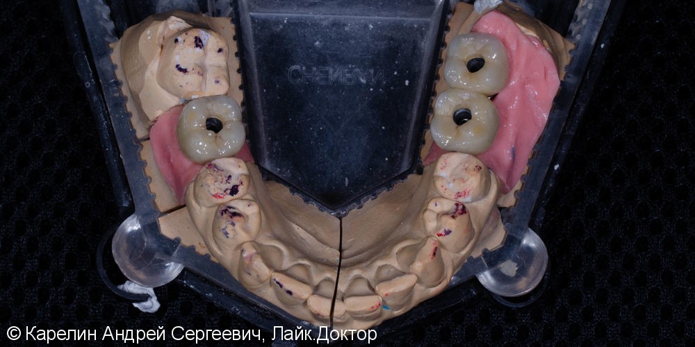 Травма нижнечелюстного нерва после резекции корней 3.7 зуба - фото №11