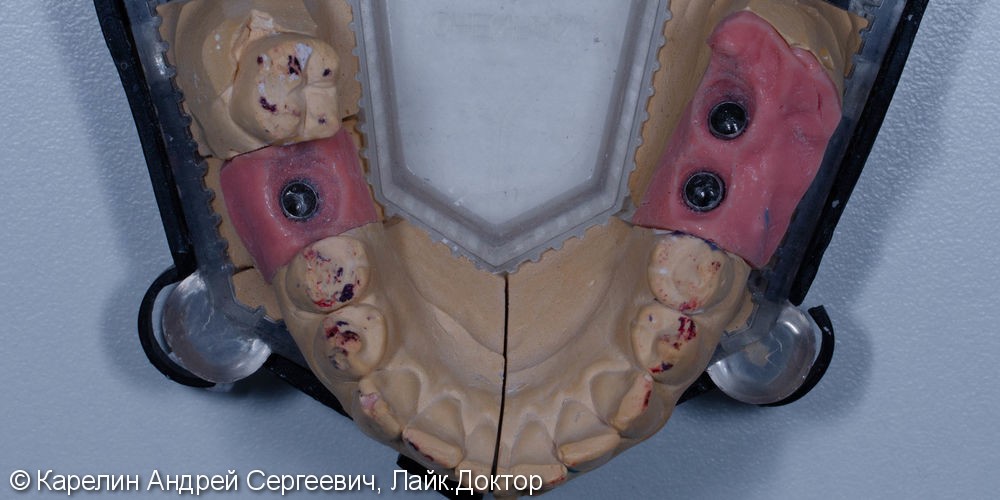 Травма нижнечелюстного нерва после резекции корней 3.7 зуба - фото №13