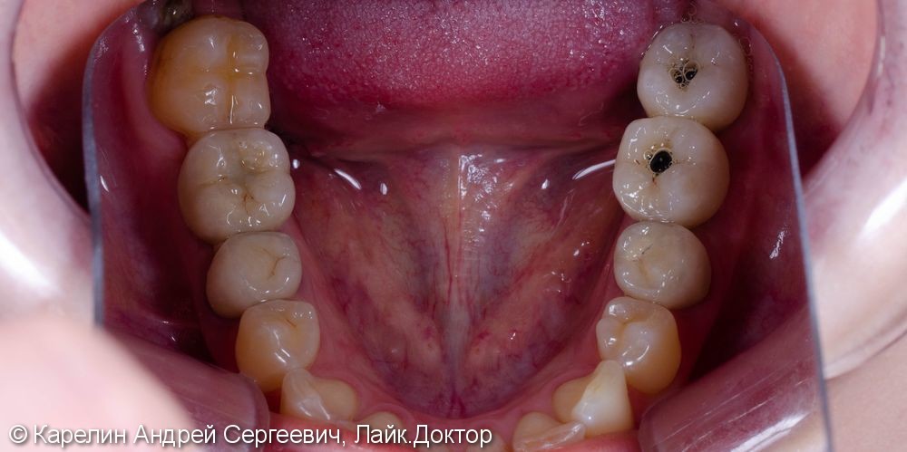Травма нижнечелюстного нерва после резекции корней 3.7 зуба - фото №14
