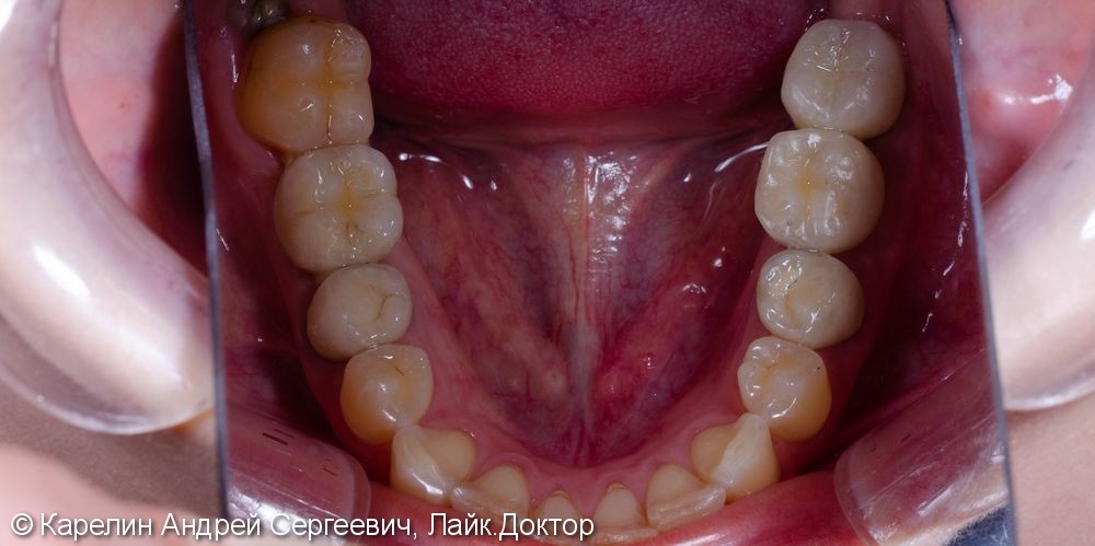 Травма нижнечелюстного нерва после резекции корней 3.7 зуба - фото №15