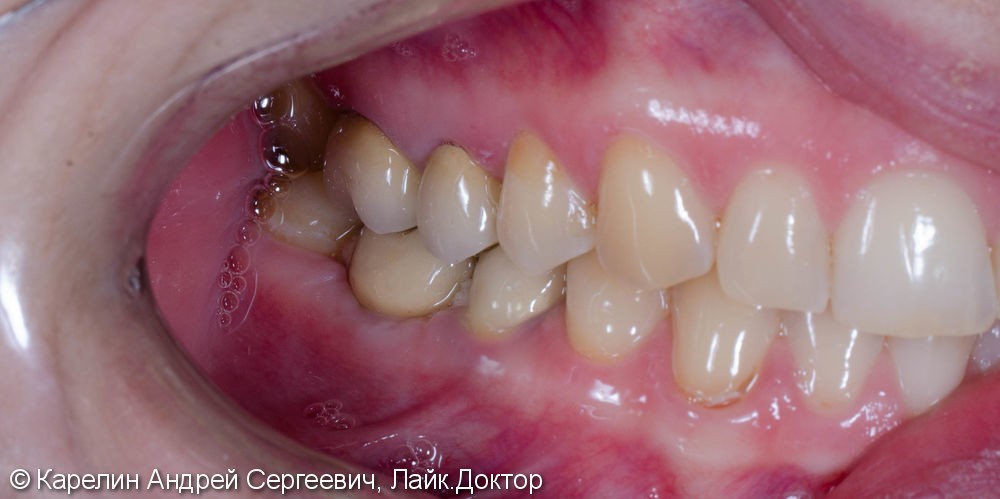 Травма нижнечелюстного нерва после резекции корней 3.7 зуба - фото №16