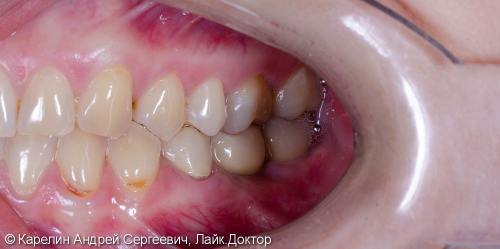 Травма нижнечелюстного нерва после резекции корней 3.7 зуба - фото №17