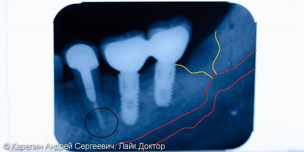 Травма нижнечелюстного нерва после резекции корней 3.7 зуба - фото №19