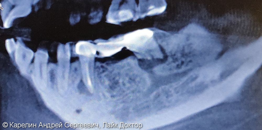 Травма нижнечелюстного нерва после резекции корней 3.7 зуба - фото №1