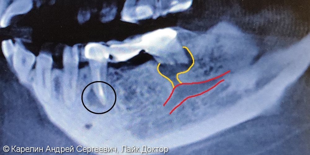Травма нижнечелюстного нерва после резекции корней 3.7 зуба - фото №2