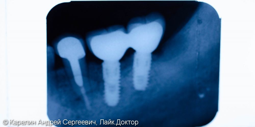 Травма нижнечелюстного нерва после резекции корней 3.7 зуба - фото №18