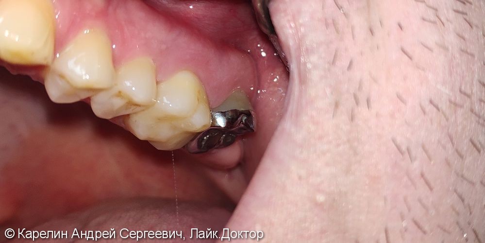 Лечение гранулематозного периодонтита зуба 2.7, удаление зуба 2.8, имплантация в области 3.6 зуба - фото №3