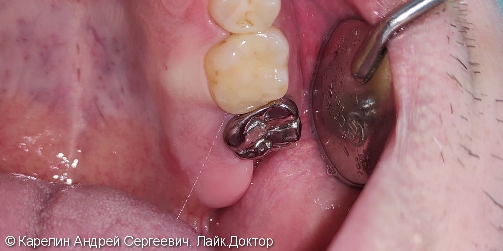 Лечение гранулематозного периодонтита зуба 2.7, удаление зуба 2.8, имплантация в области 3.6 зуба - фото №4