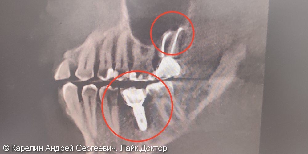 Лечение гранулематозного периодонтита зуба 2.7, удаление зуба 2.8, имплантация в области 3.6 зуба - фото №6