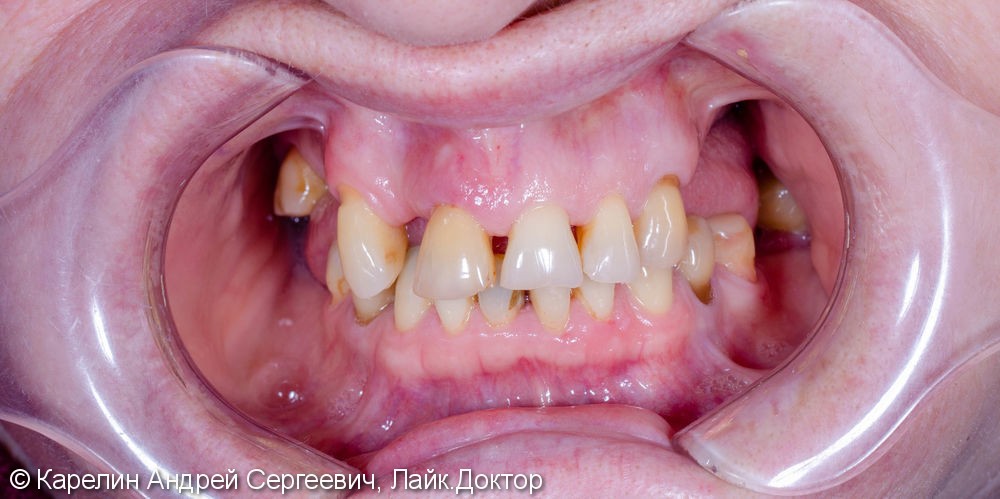 Лечение частичной вторичной адентии обеих челюстей - фото №2