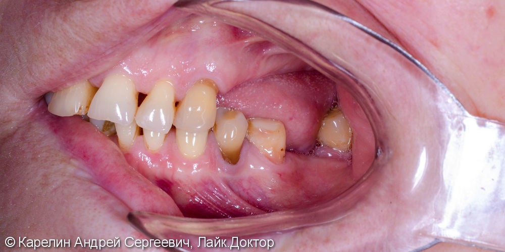 Лечение частичной вторичной адентии обеих челюстей - фото №4