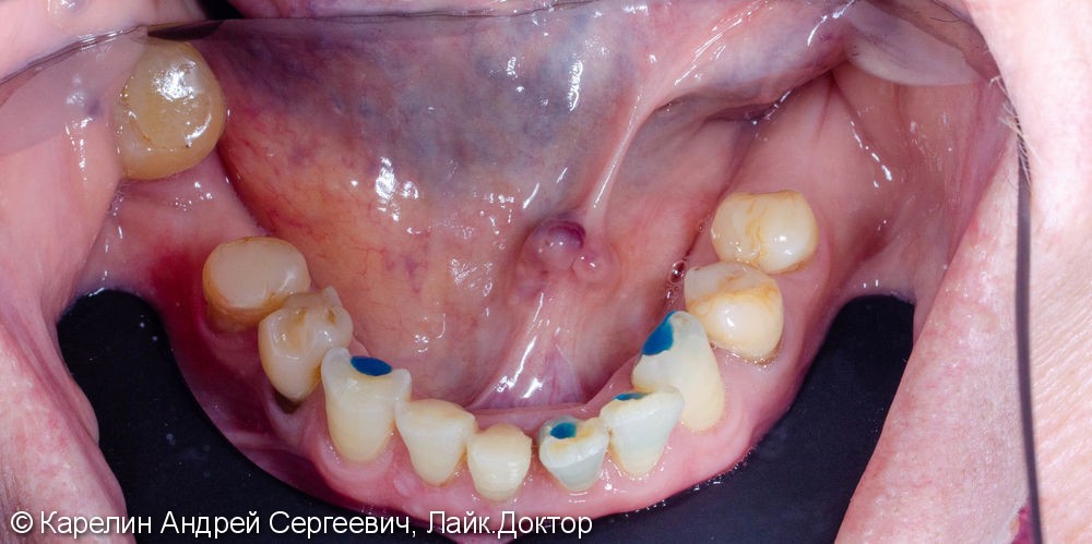 Лечение частичной вторичной адентии обеих челюстей - фото №6
