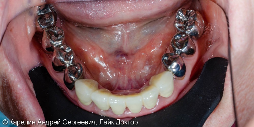 Лечение частичной вторичной адентии обеих челюстей - фото №10