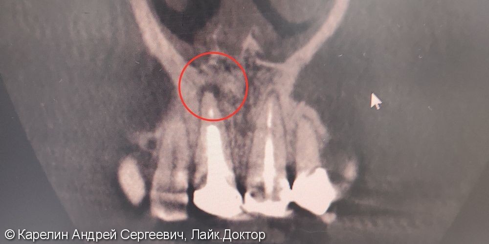 Лечение периодонтита зуба 2.1 - фото №1
