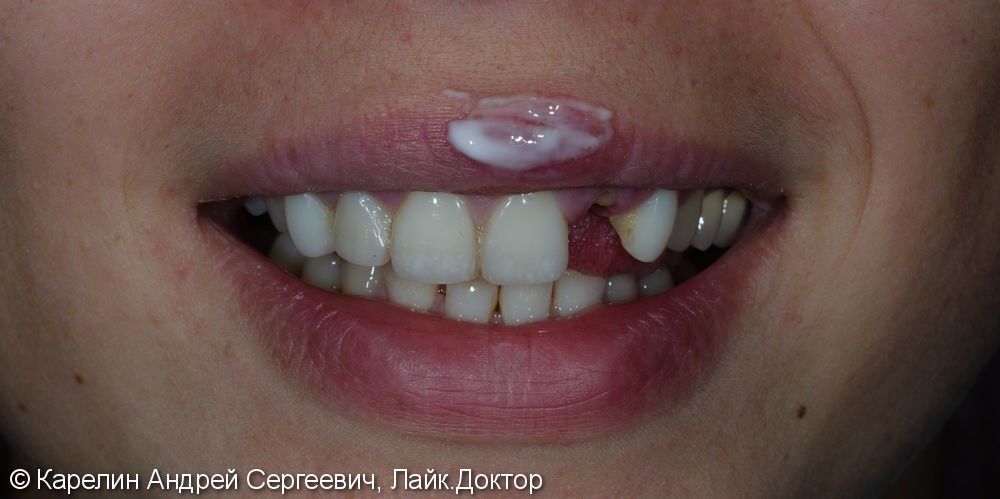 Восстановление зуба 2.2 с помощью культевой вкладки и коронки на основе диоксида циркония - фото №1
