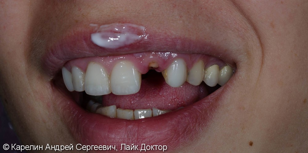 Восстановление зуба 2.2 с помощью культевой вкладки и коронки на основе диоксида циркония - фото №2