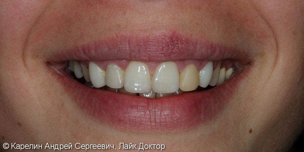 Восстановление зуба 2.2 с помощью культевой вкладки и коронки на основе диоксида циркония - фото №3