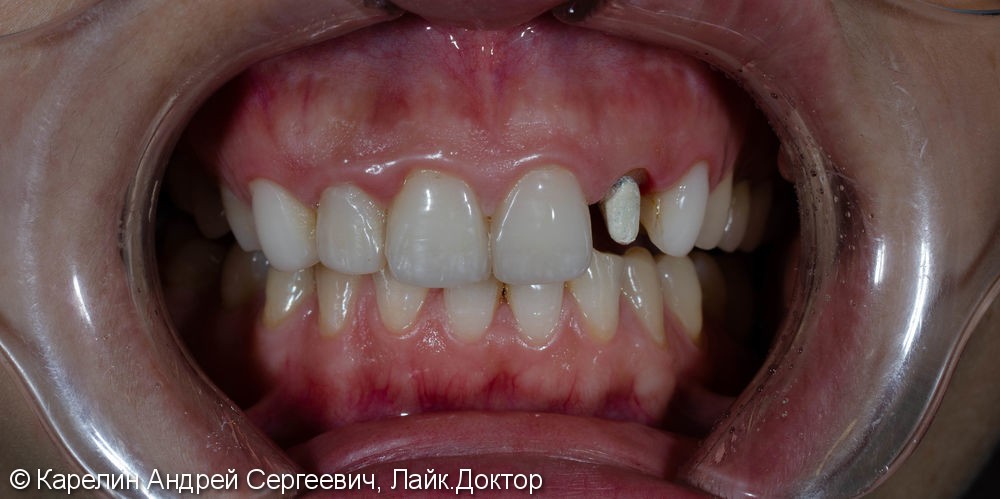 Восстановление зуба 2.2 с помощью культевой вкладки и коронки на основе диоксида циркония - фото №4