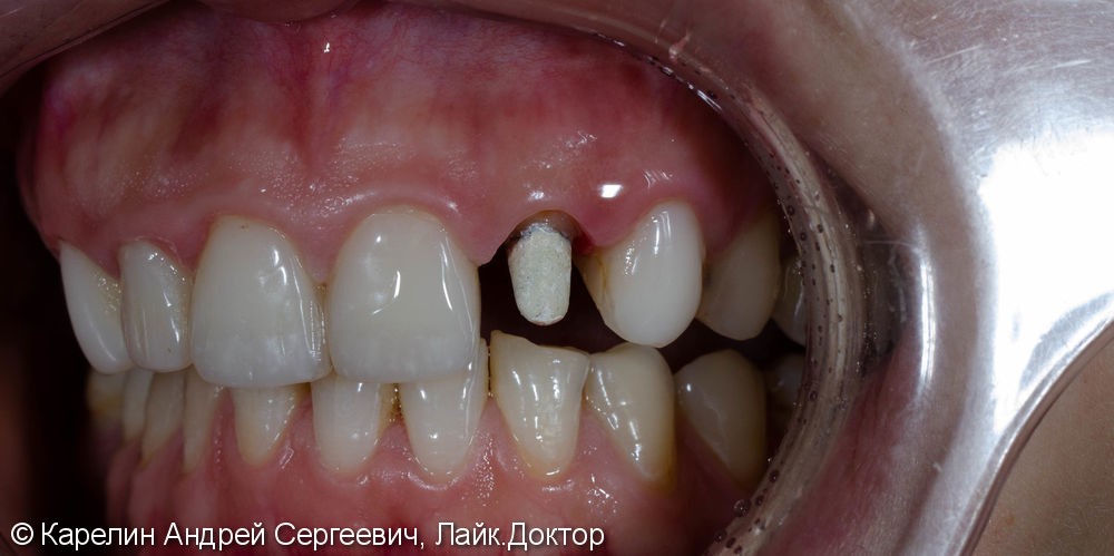 Восстановление зуба 2.2 с помощью культевой вкладки и коронки на основе диоксида циркония - фото №5