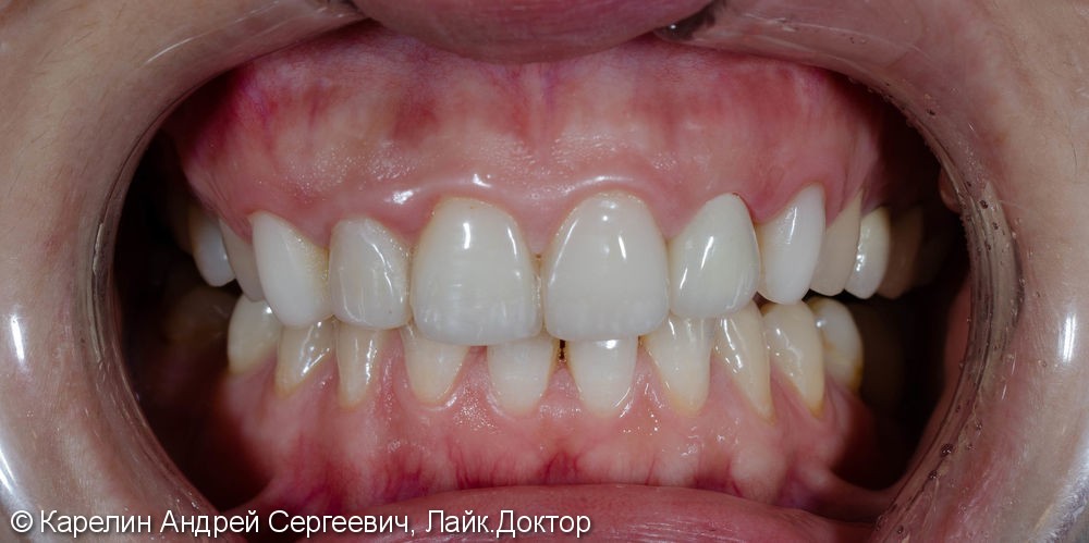 Восстановление зуба 2.2 с помощью культевой вкладки и коронки на основе диоксида циркония - фото №6