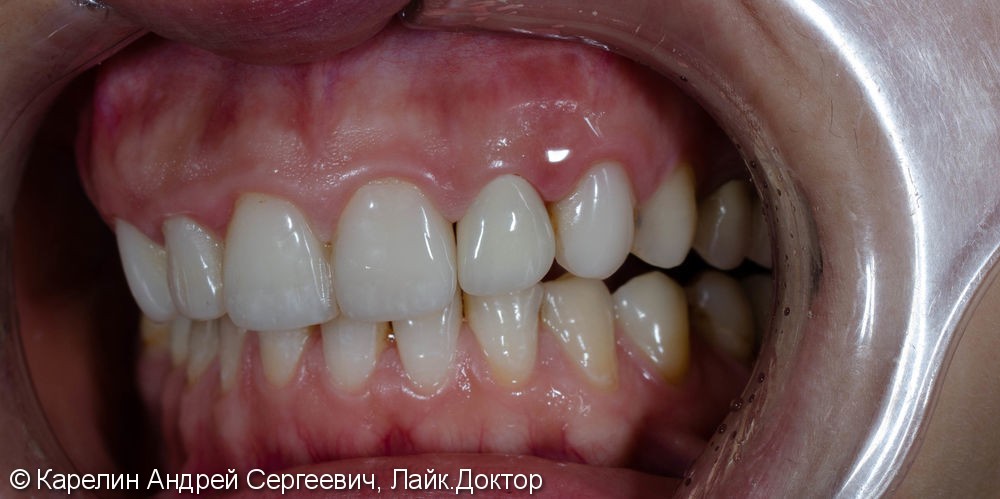 Восстановление зуба 2.2 с помощью культевой вкладки и коронки на основе диоксида циркония - фото №7