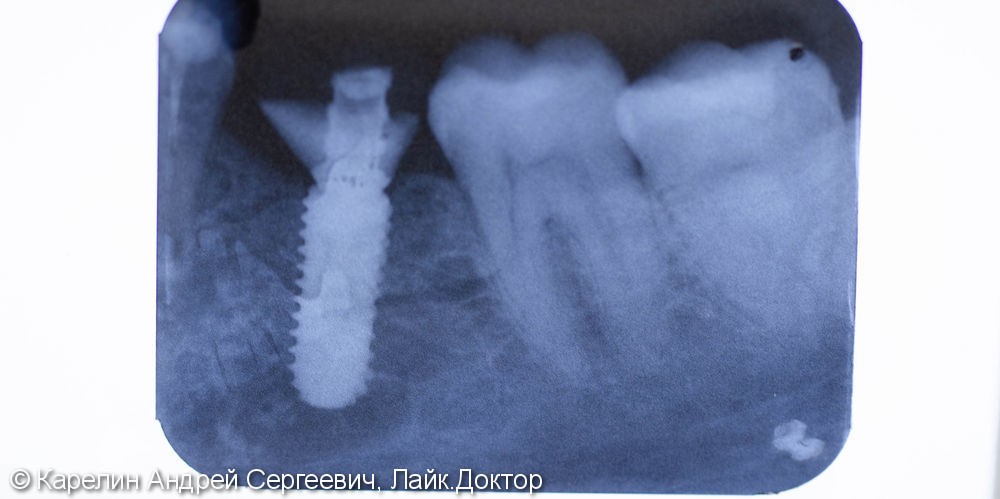 Установка имплантата OSSTEM с немедленной нагрузкой и конечный результат - фото №5