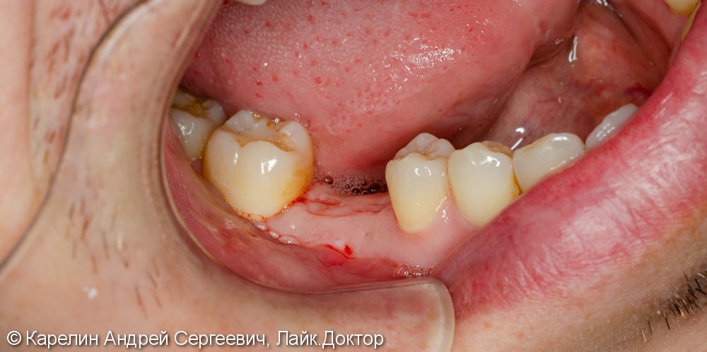 Имплантация зуба 4.6 - фото №1