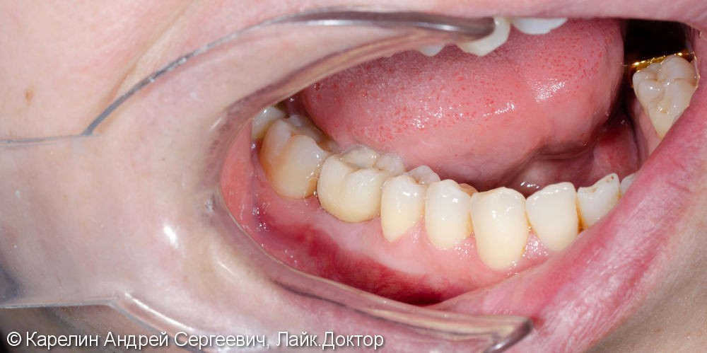 Имплантация зуба 4.6 - фото №8