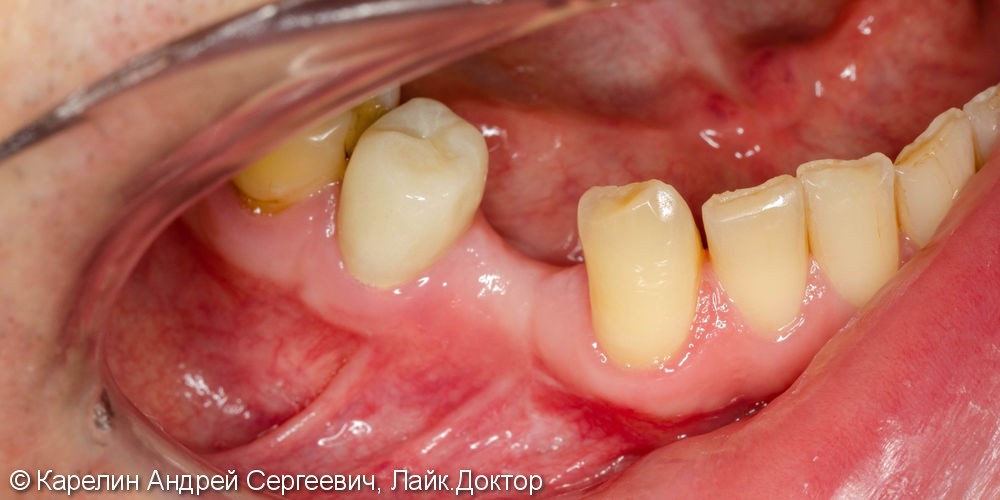 Имплантация в области зуба 4.4 с пластикой десны - фото №1