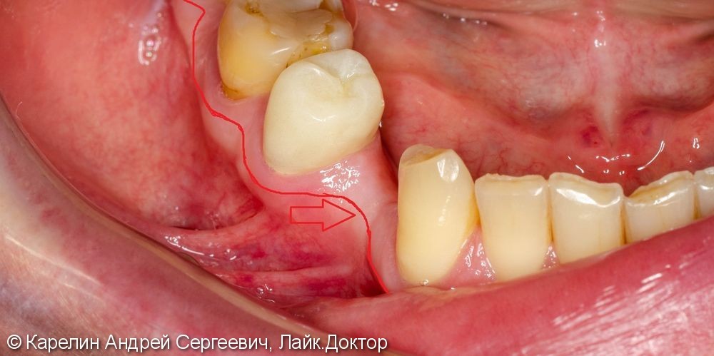 Имплантация в области зуба 4.4 с пластикой десны - фото №2