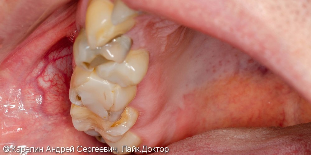 Имплантация в области зуба 4.4 с пластикой десны - фото №3
