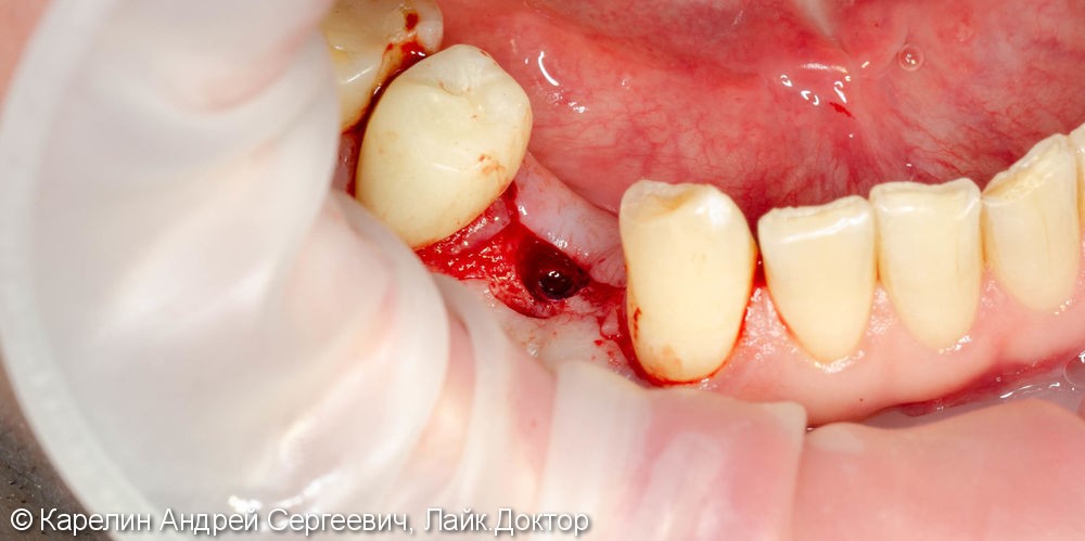 Имплантация в области зуба 4.4 с пластикой десны - фото №4