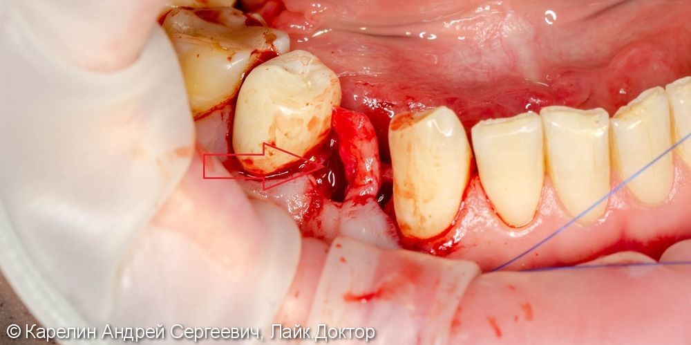 Имплантация в области зуба 4.4 с пластикой десны - фото №8