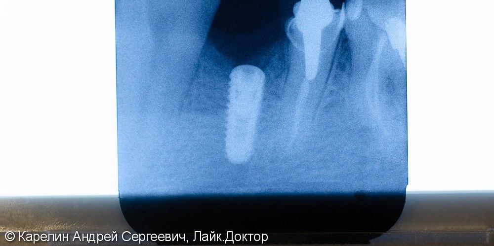 Имплантация в области зуба 4.4 с пластикой десны - фото №9