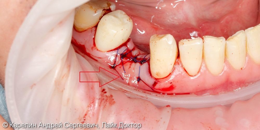 Имплантация в области зуба 4.4 с пластикой десны - фото №10